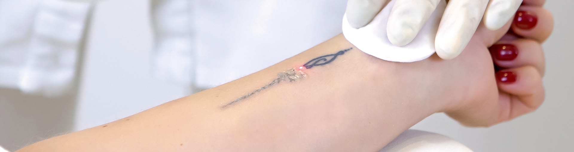 gaja a fazer remoção de tatuagem com laser site Episense clínica de medicina estética facial e corporal no Porto - Portugal