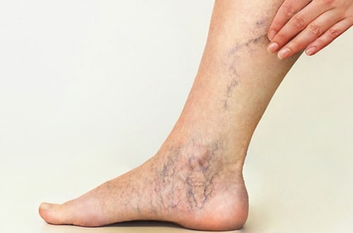 Mulher com varizes na perna e no pé